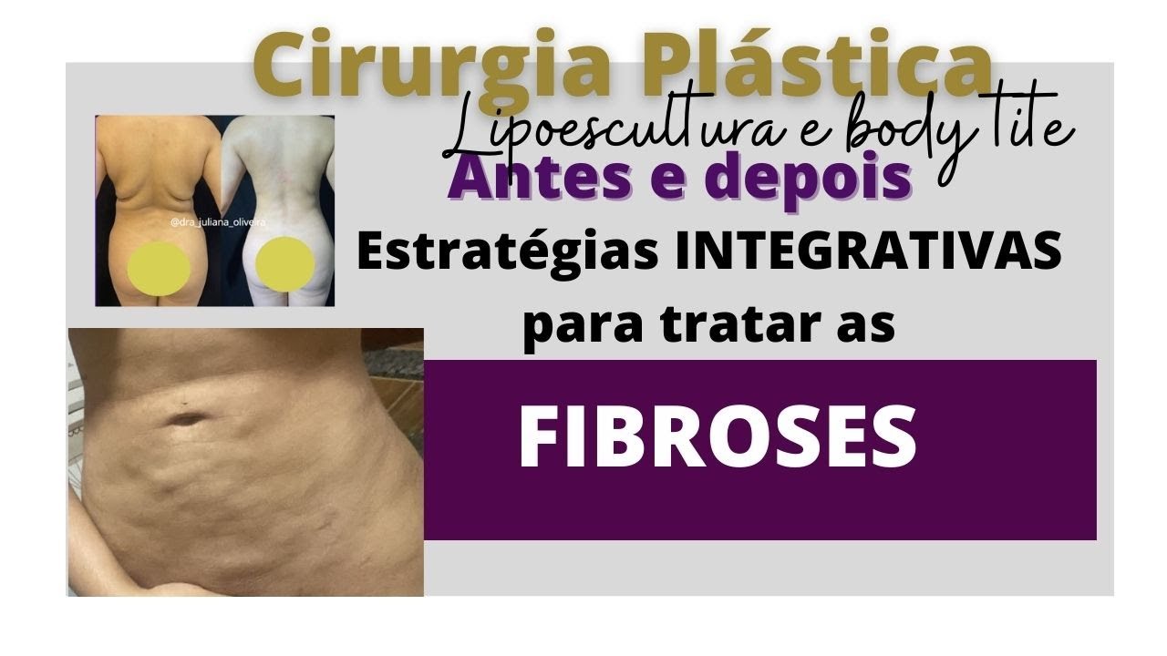 Antes e Depois Lipoescultura com Body Tite : Estratégias Integrativas para tratar as Fibroses