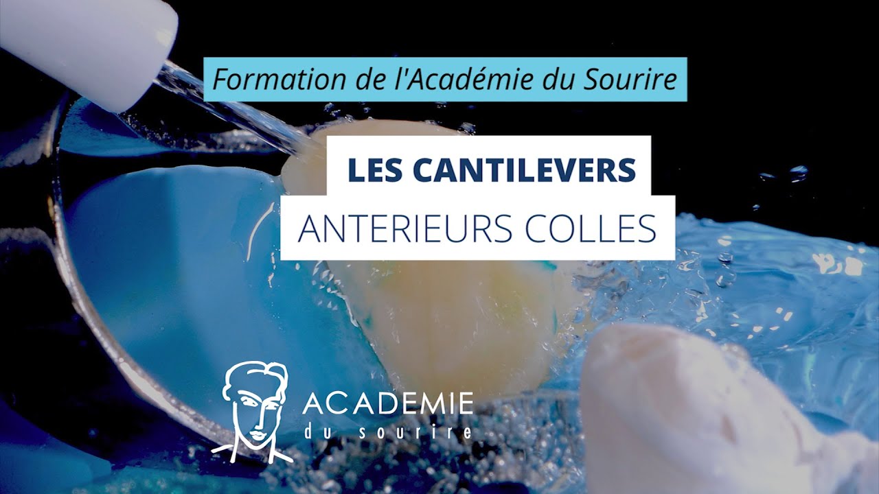 Cantilevers antérieurs collés