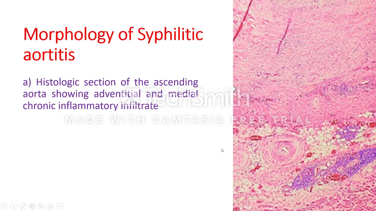Tertiary syphilis; Cardiovascular syphilis.
