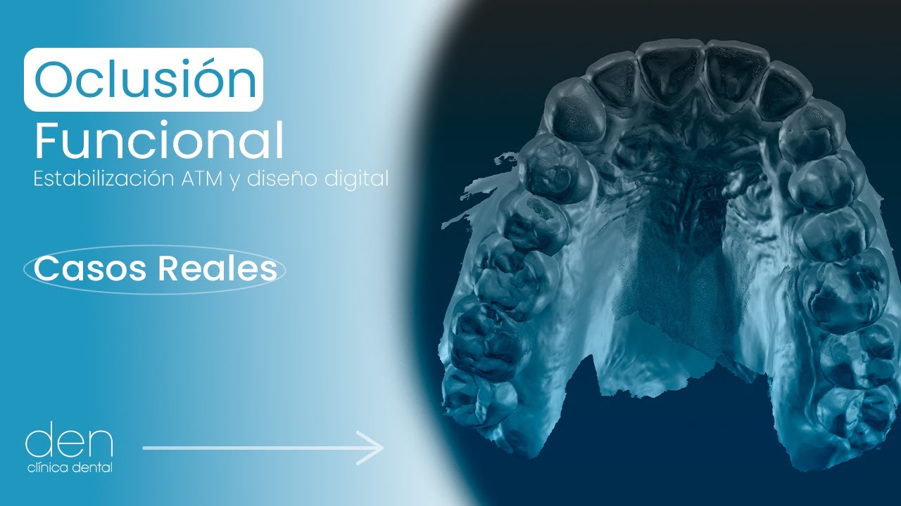 Oclusión Funcional ¡Estabilización de ATM y diseño digital de sonrisa!
