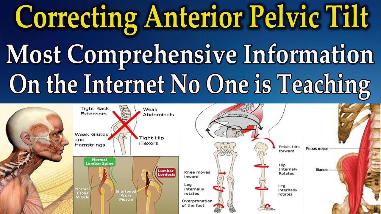 Correcting Anterior Pelvic Tilt (Best Information on the Internet No One is Teaching) - Dr Mandell