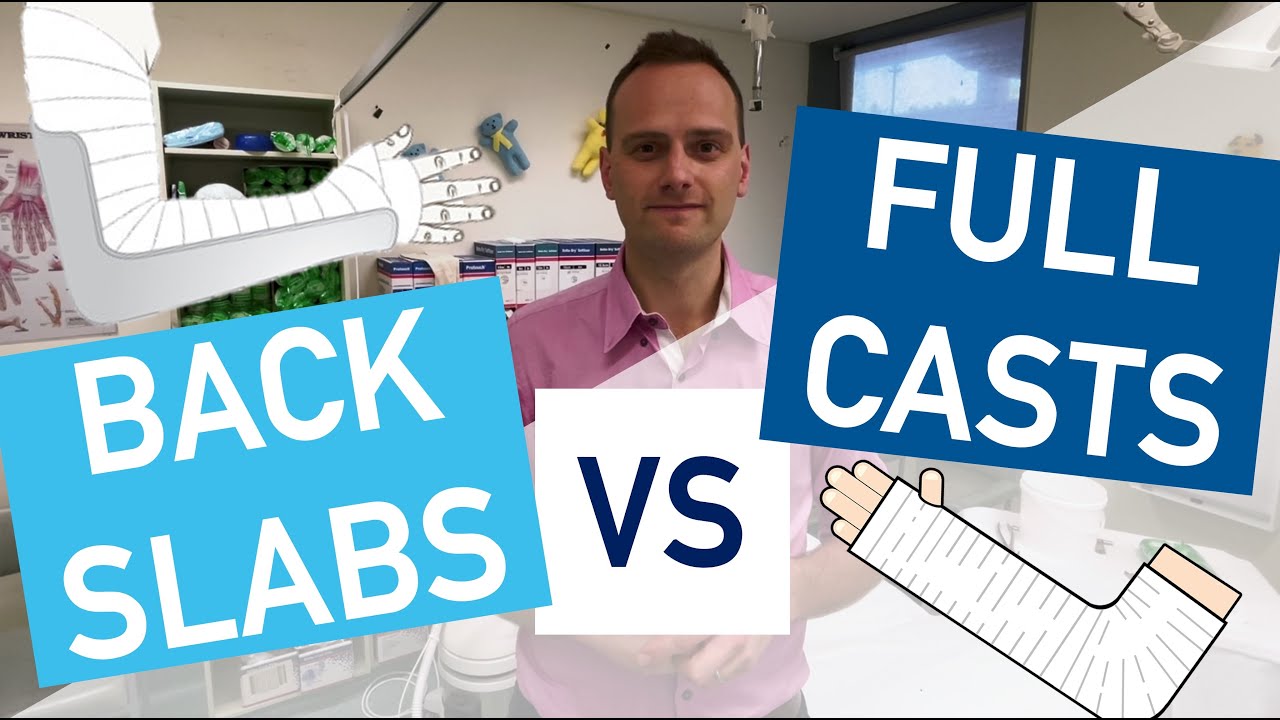 Casting: Back Slabs vs. Full Casts Explained