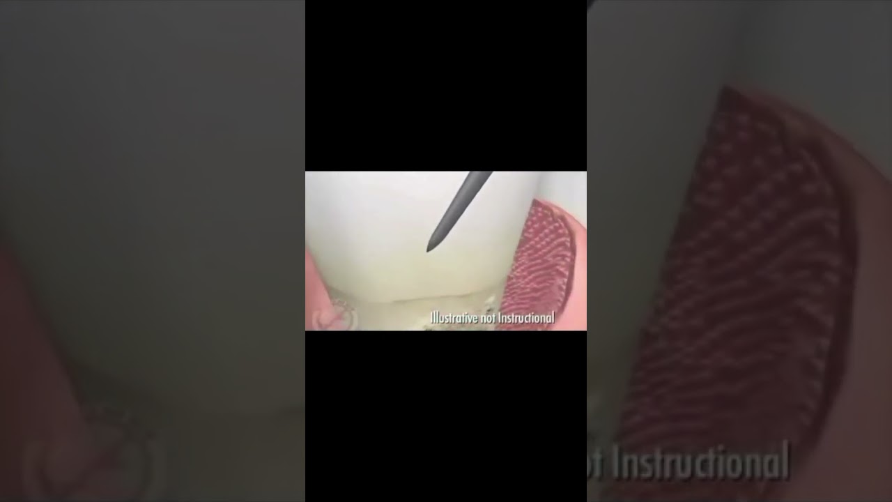 LANAP (Laser Assisted New Attachment Procedure)