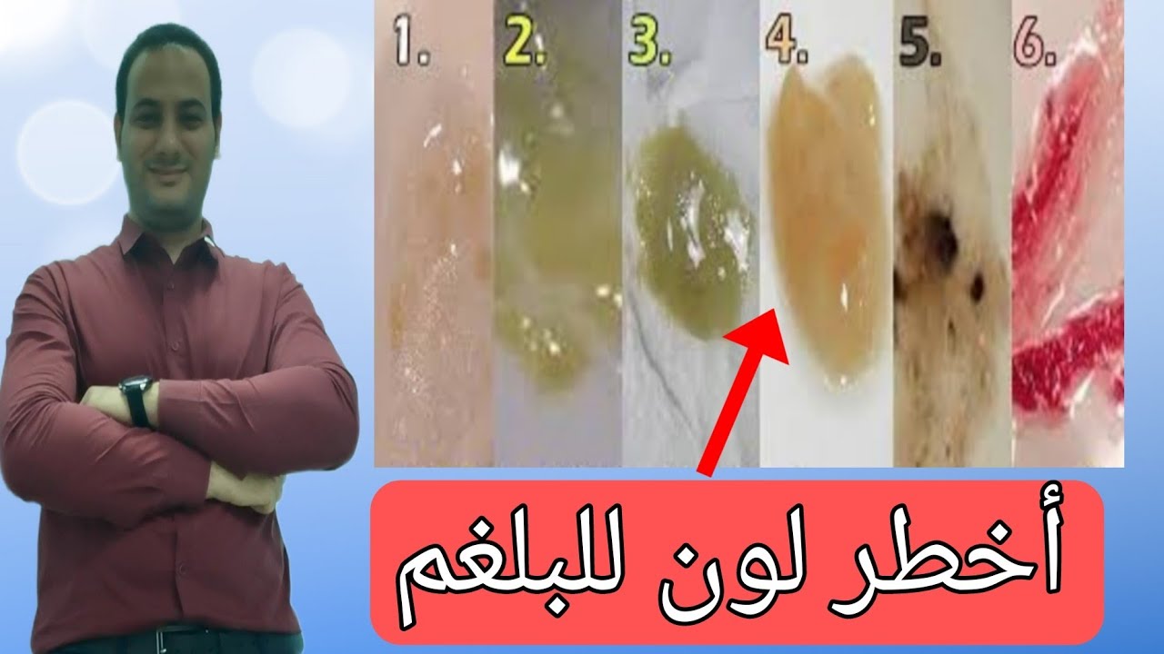 لون البلغم ماذا يخبرك عن جسمك وماذا يدل | أفضل حل للتخلص من البلغم والافرازات