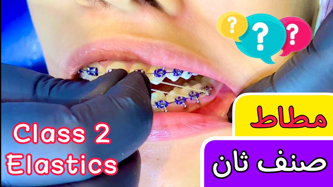 مطاط التقويم صنف ثان | كيف يتم تركيب المطاط المنزلي و ايه السبب ؟ | قربنا فك تقويم الأسنان باق جلسة