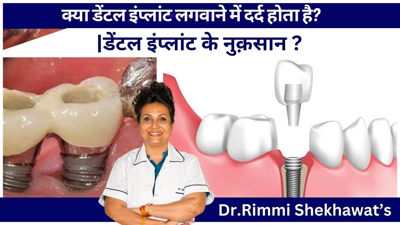 क्या डेंटल इंप्लांट लगवाने में दर्द होता है?  | डेंटल इंप्लांट के नुक़सान ?