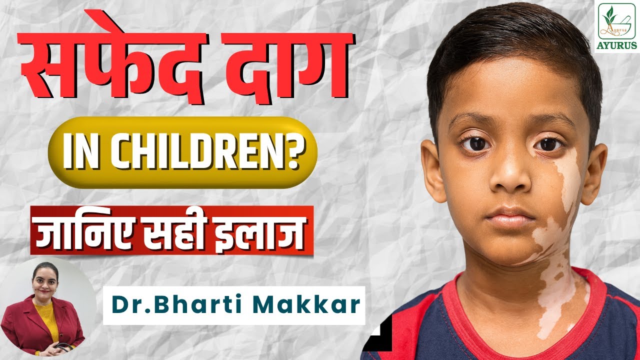 Vitiligo in Children: Gentle Ayurvedic Care, Diet & Parenting&nbsp;Tips | Diet & Emotional Support