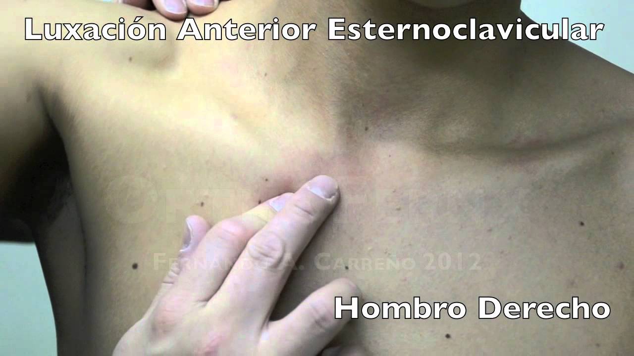 VIDEO DE LUXACION ANTERIOR DE ESTERNOCLAVICULAR DER.mov