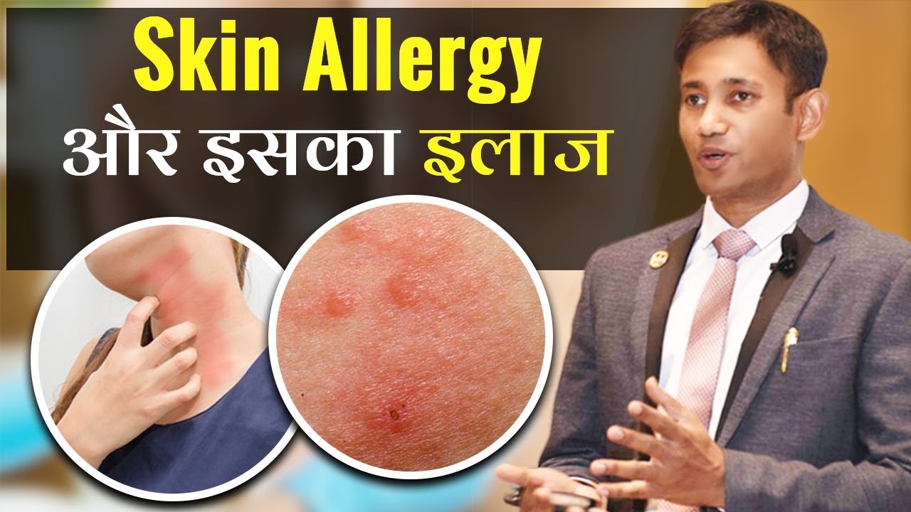Skin Allergy Treatment at Home | Itching | Khujli Ka Gharelu Ilaj | Dr. Biswaroop Roy Chowdhury
