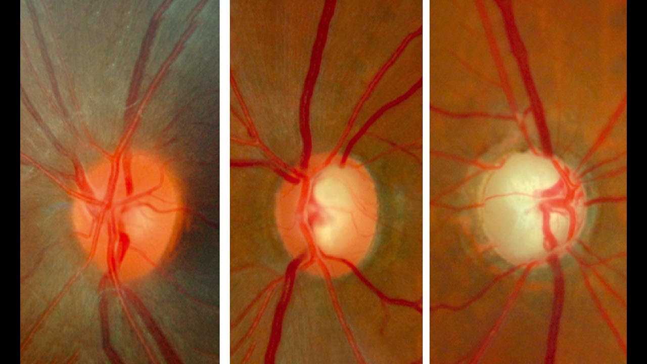 Una molécula podría restaurar la función visual tras una lesión del nervio óptico