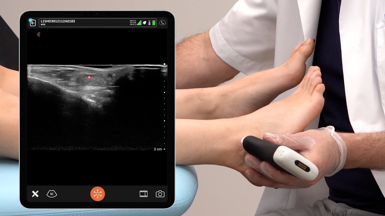 Ultrasound of the Peroneal Tendons