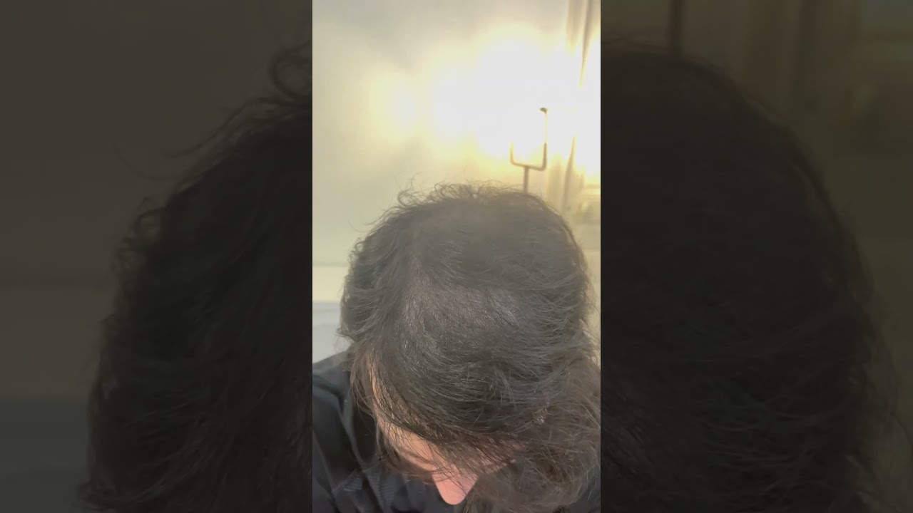 Tricopigmentation Paris - Micropigmentation capillaire par Sopigment