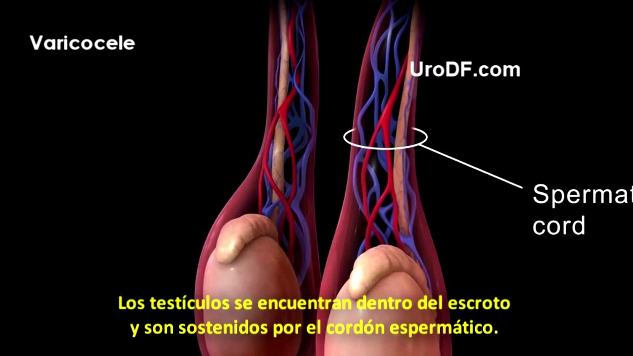 Varicocele