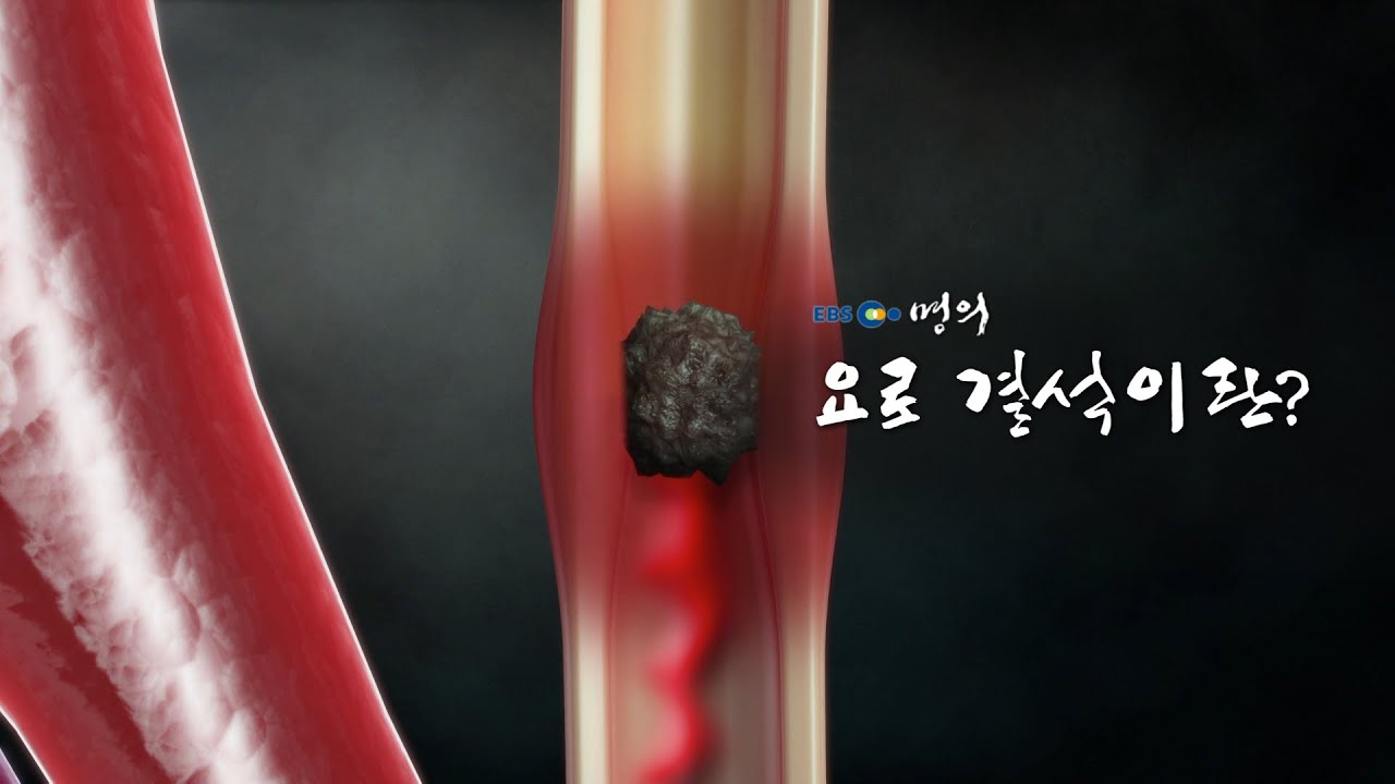 [명의 의학백과📖]요로 결석이란?