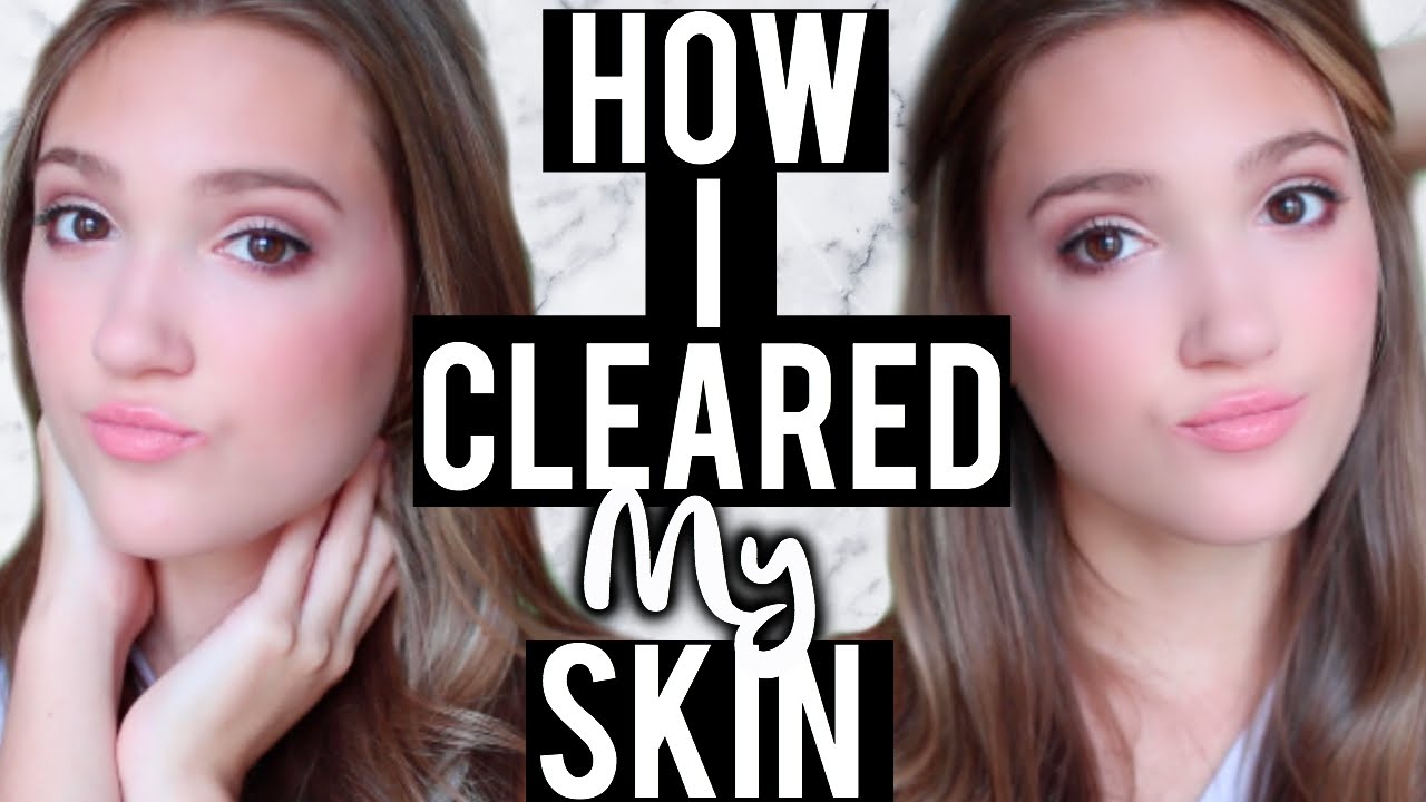 How I Cleared My Skin For Good | Accutane Experience