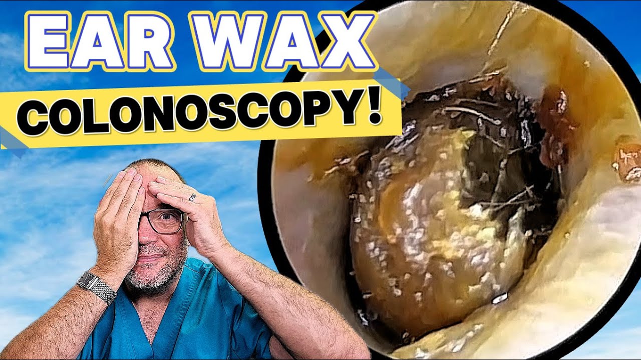 Ear Wax COLONOSCOPY! Episode 592