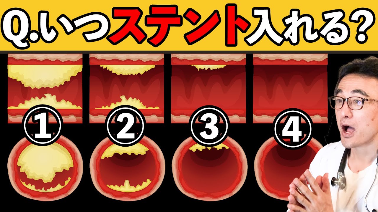 【動脈硬化】心臓のステント治療メリットと危険性を正しく理解しよう！循環器内科医が解説