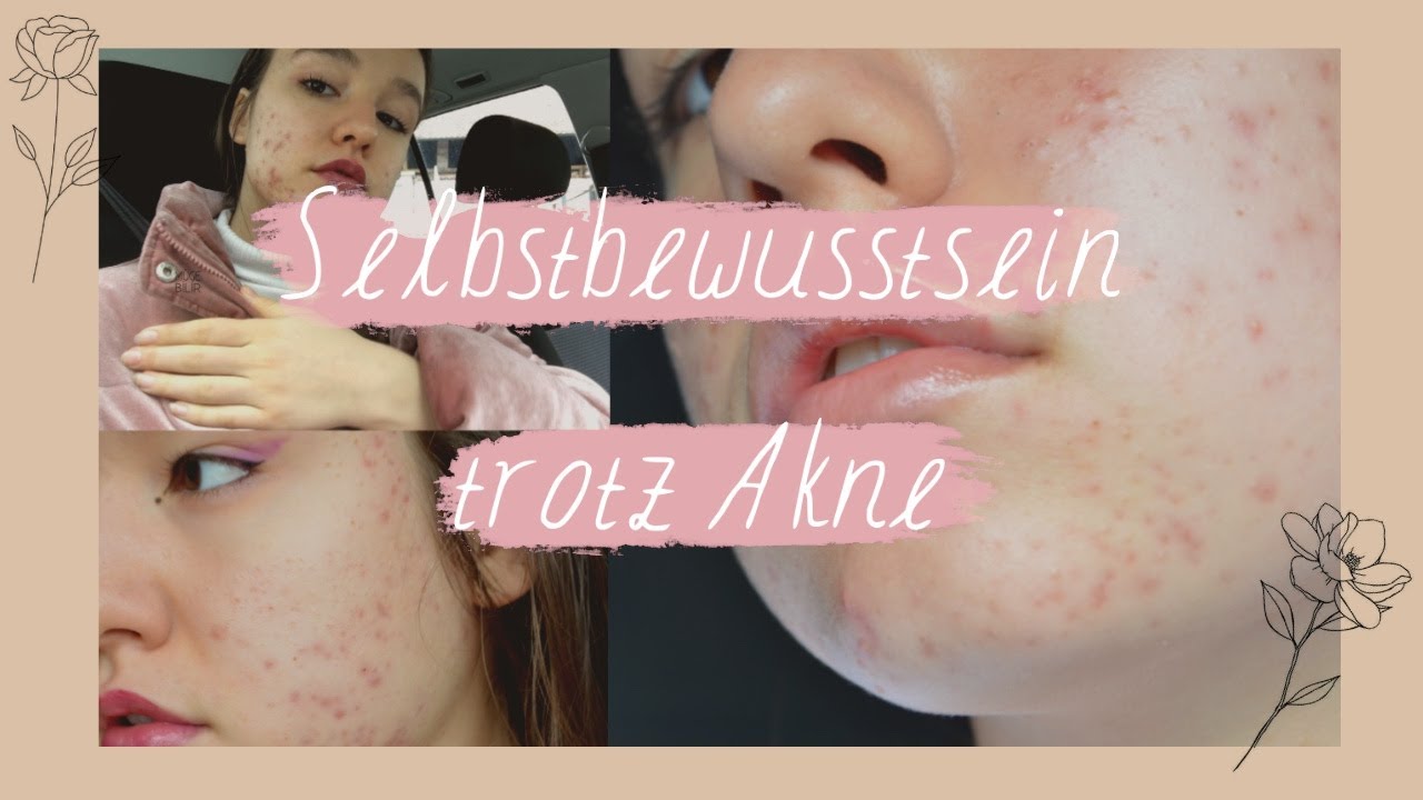 SELBSTBEWUSST TROTZ AKNE - Meine Gedanken zu Selbstliebe und Hautproblemen