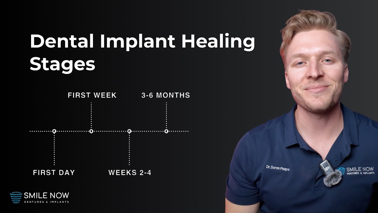 All-On-6 Dental Implant Healing Stages: Complete Dental Implant Recovery Guide