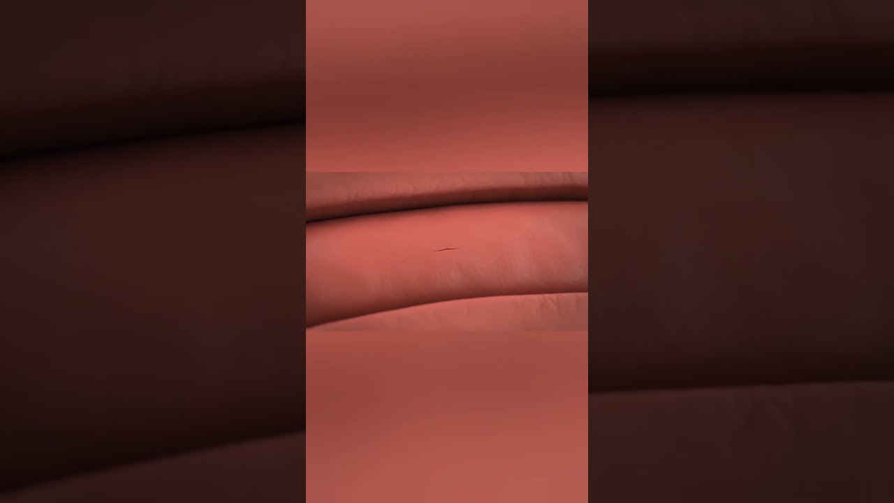Anal Fissure: Painful Tear in the Anus