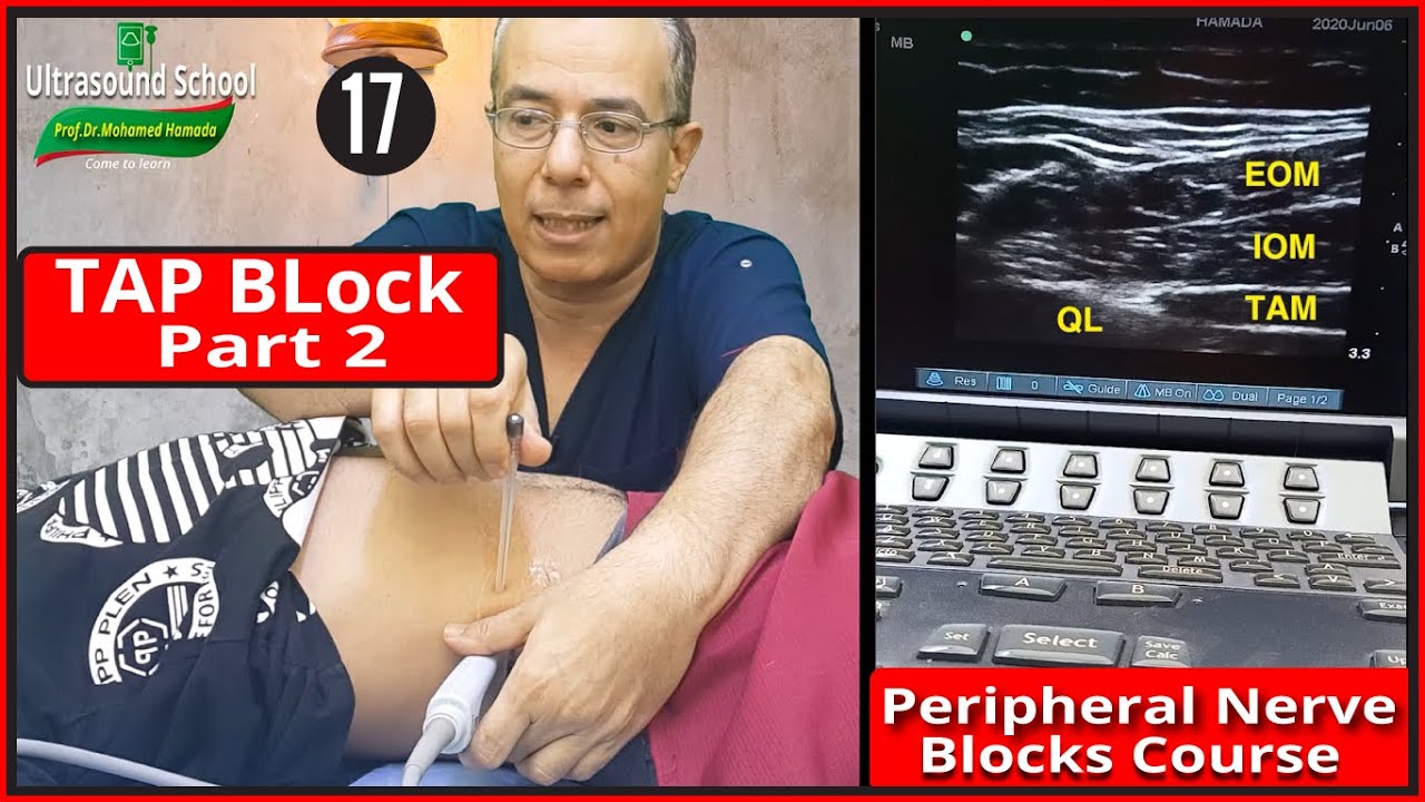 TAP Block part2)Ultrasound Guided peripheral Nerve Blocks Course |Mohamed Hamada|(17)