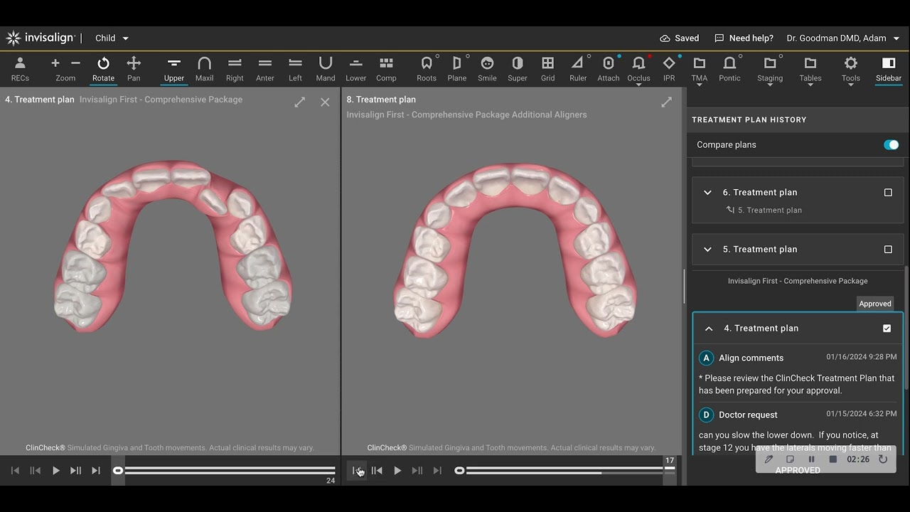 J.L. Invisalign First Case Progress in less that 6 months