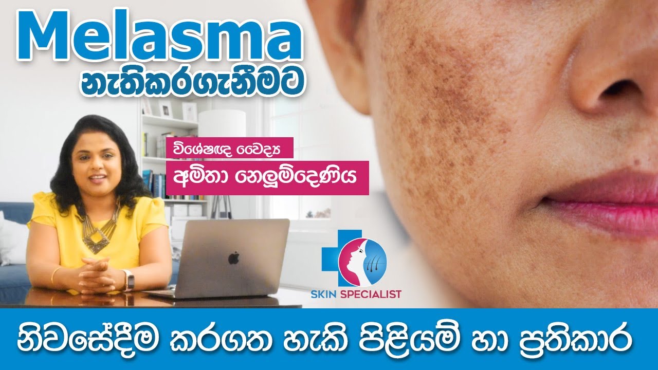 Melasma නැති කරගැනීමට නිවසේදි කල හැකි පිළියම් හා ප්‍රතිකාර | Skin Specialist