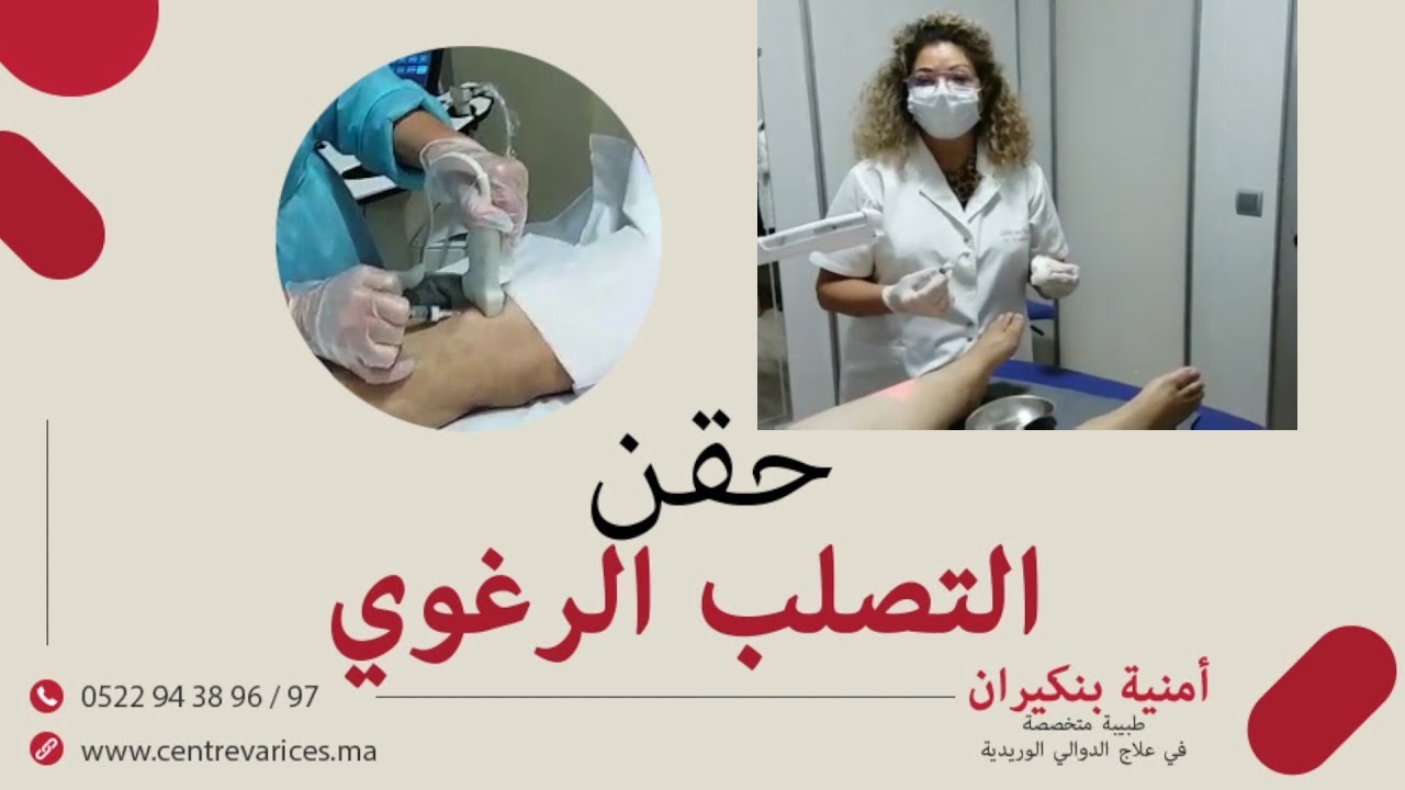الدكتورة أمنية بنكيران :  حقن التصلب الرغوي لعلاج الدوالي ...أحسن بديل للعملية الجراحية