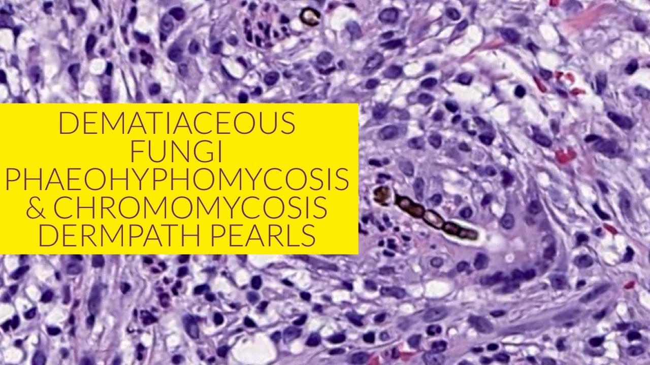 Dematiaceous fungi - phaeohyphomycosis and chromomycosis unknown 13