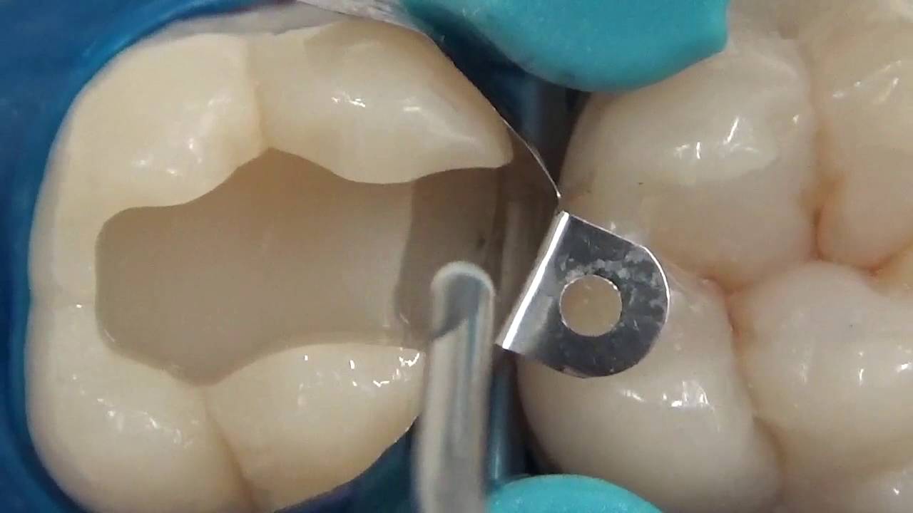 Restauração classe II utilizando matriz proximal Palodent V3 (Dentsply)
