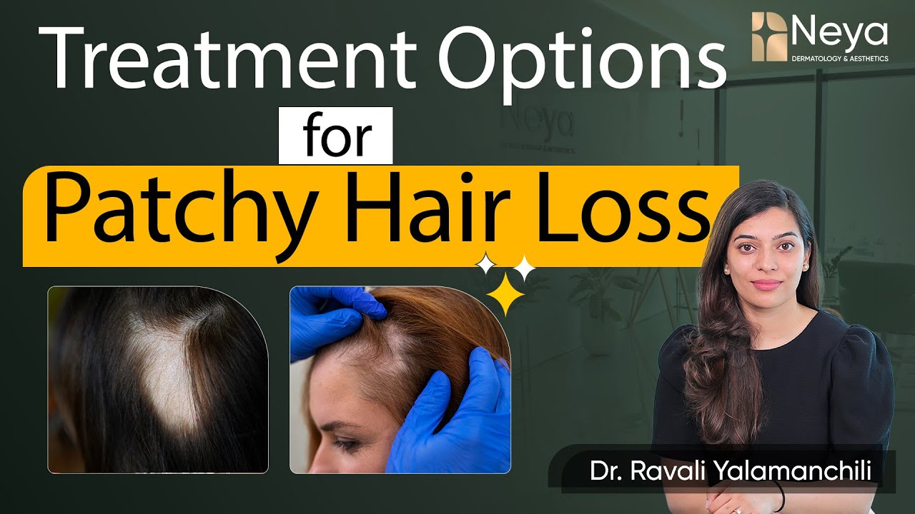 Patchy hair loss Treatment | Alopecia Areata | Hair Fall Treatment in Hyderabad