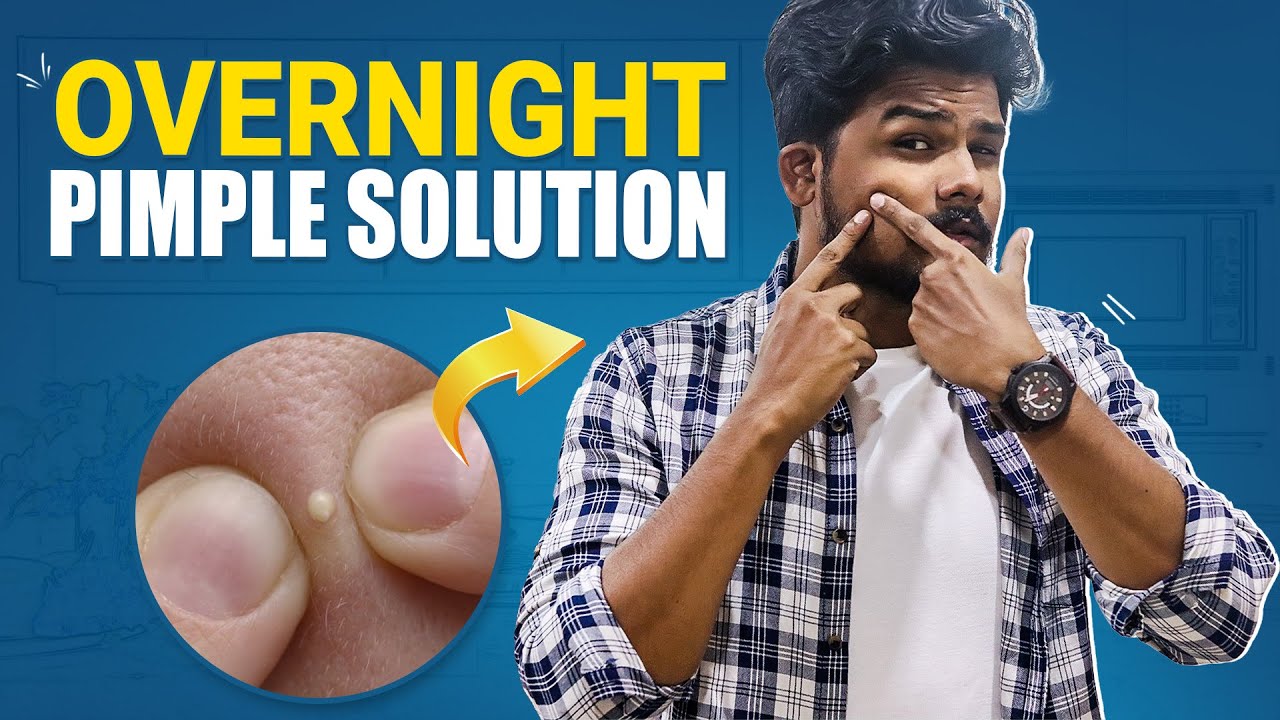 How To Get Rid Of PIMPLES OVERNIGHT | Simple Home Remedies | Men's Grooming In Telugu | TFV