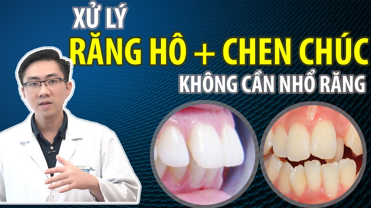 Case #5: Vĩnh Biệt Răng Hô Và Răng Chen Chúc Mà Không Cần Nhổ Răng | Bác Sĩ Nam Bùi Vinalign