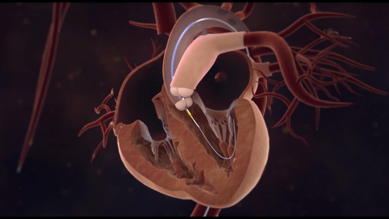 Transcatheter Aortic Valve Implantation (TAVI)