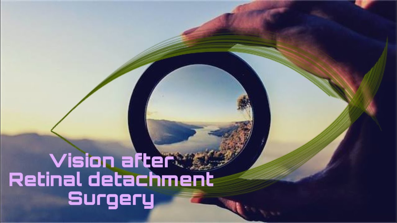12: How Is VISION after retinal detachment surgery / RETINAL DETACHMENT/ #retinaldetachment