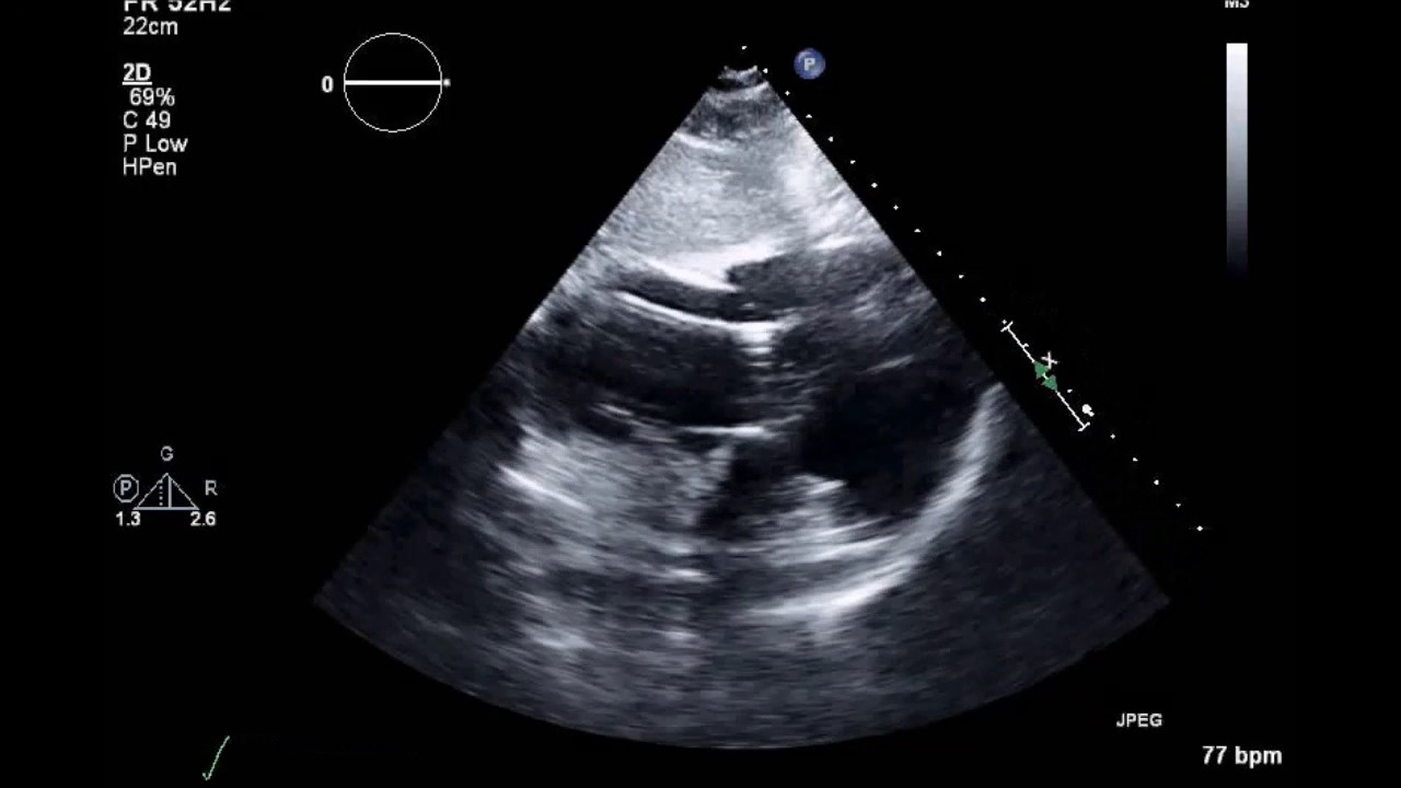 What A Pacemaker Wire Looks Like On An Echocardiogram