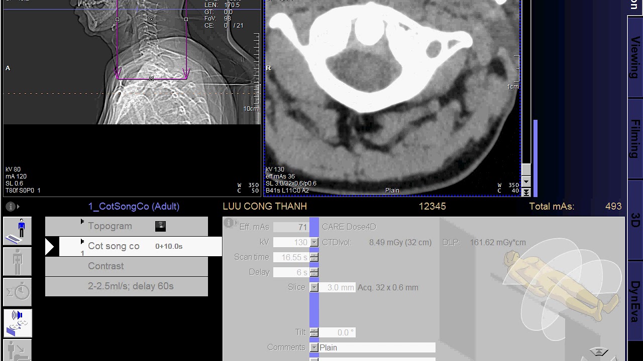 CT Scan of the Cervical Spine (SIEMEN) - CLVT Cột sống cổ