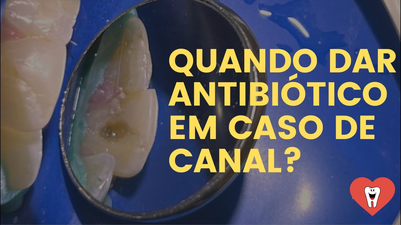 QUANDO DAR ANTIBIÓTICO EM CASO DE CANAL?