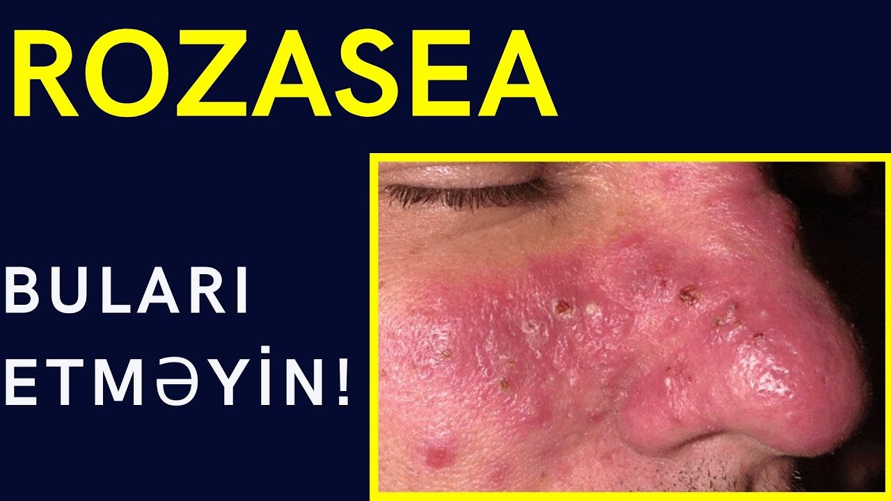 ROZASEA (Qızılg&uuml;l) Xəstəliyı Nədir? i- Bunlar Xəstəliyi Daha da Qıcıqlandırır!