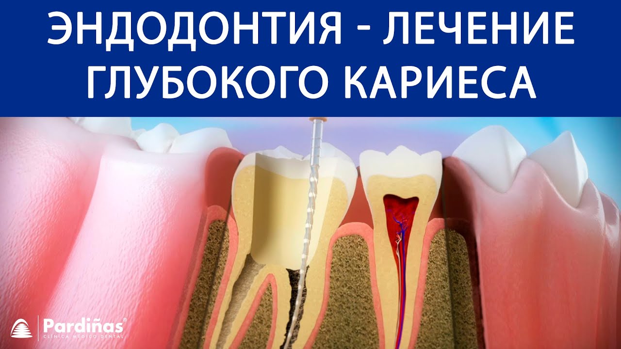 Эндодонтия - Лечение глубокого кариеса &copy;