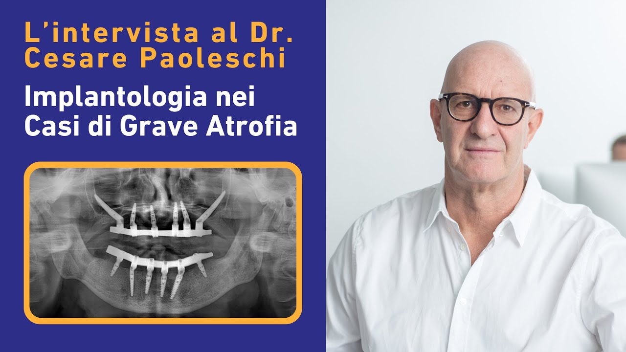 Implantologia nei Casi di Grave Atrofia: Intervista al Dr. Cesare Paoleschi