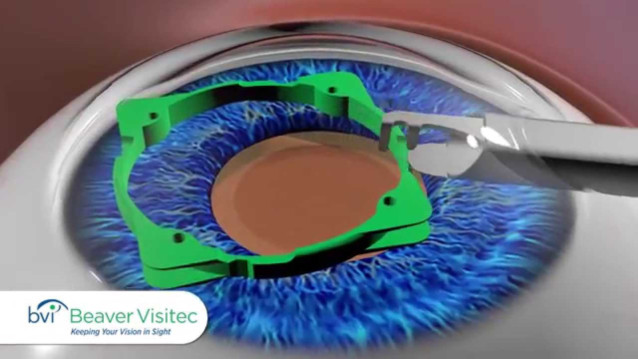 Visitec® I-Ring® Pupil Expander