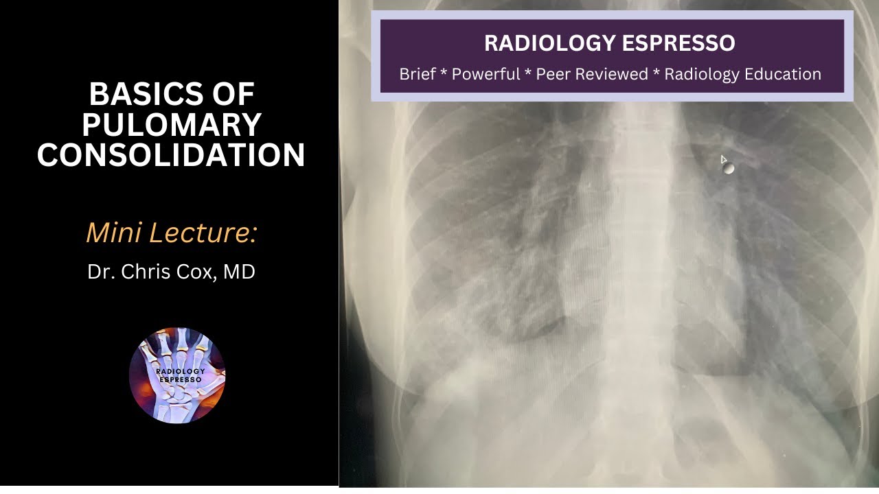 BASICS OF PULMONARY CONSOLIDATION: Mini-lecture, Dr. Chris Cox, MD
