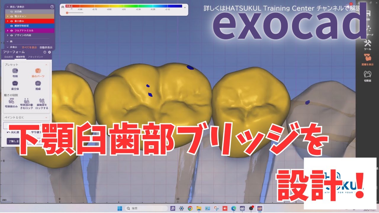 #284　exocad設計　下顎臼歯部ブリッジを設計！（解説なし版）