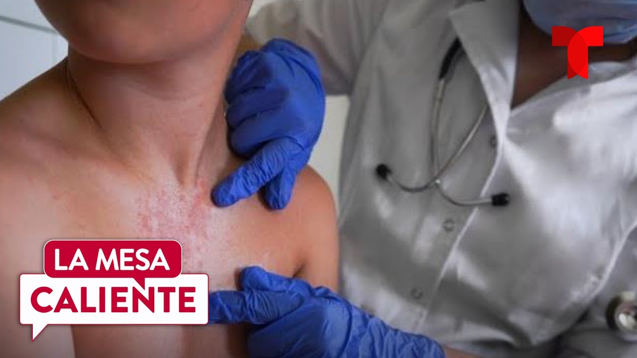 Brote de sarampión en México se intensifica y FIFA pide vacunarse | La Mesa Caliente